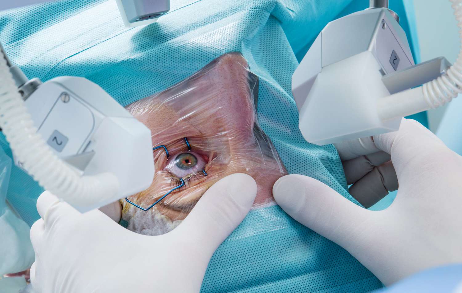 Cataract operation